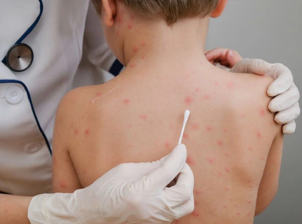 На Полтавщині зростає захворюваність на інфекційні хвороби